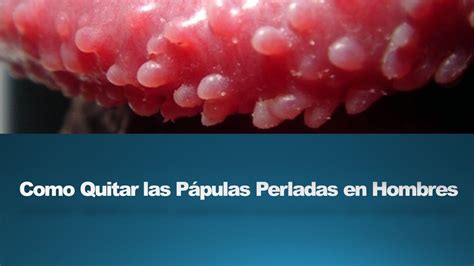 papulas perleadas|Pápulas perladas en el glande: causas y tratamiento